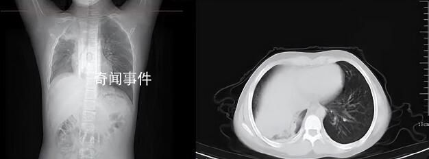 男孩咳嗽發(fā)熱在家硬扛成白肺 目前的癥狀已經(jīng)明顯好轉(zhuǎn)