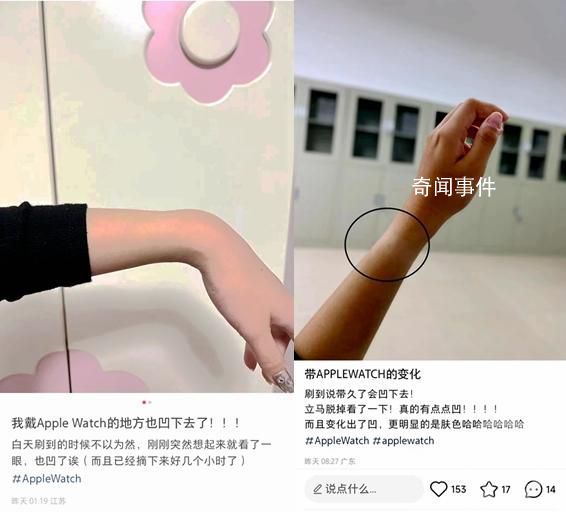 多人稱戴蘋果手表“手凹了” 摘下來(lái)幾個(gè)小時(shí)了坑還在
