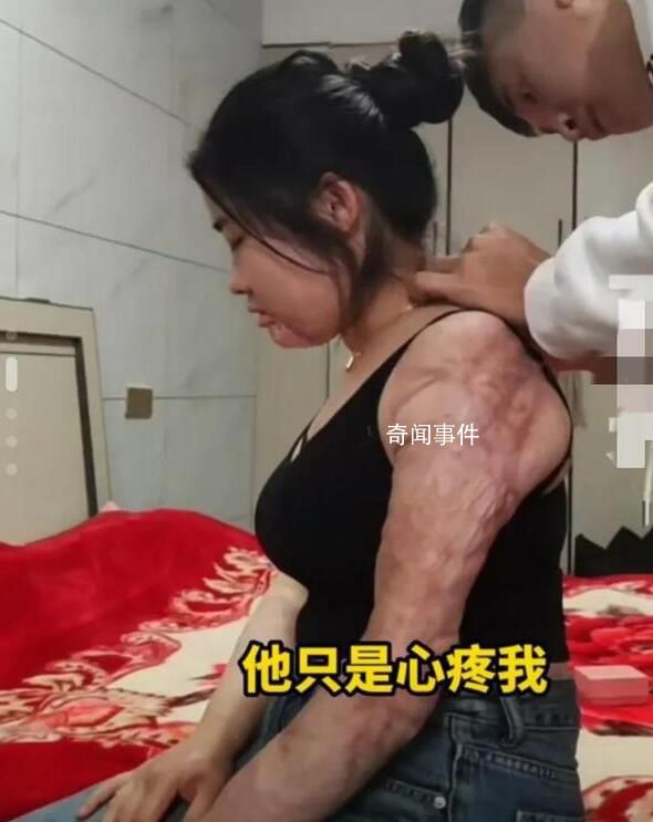 女子回應(yīng)燒傷后被男友照顧6年 表示很感謝男友的付出