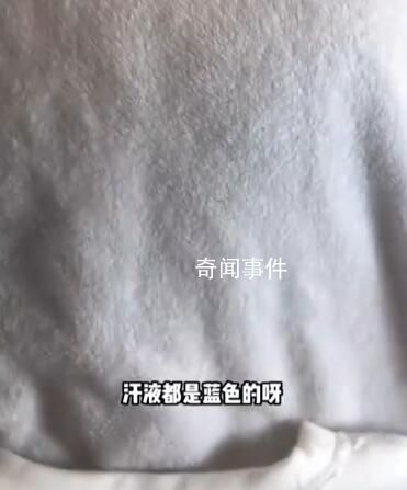 女孩出汗把衣服染藍查出色汗癥 色汗癥是怎么引起的