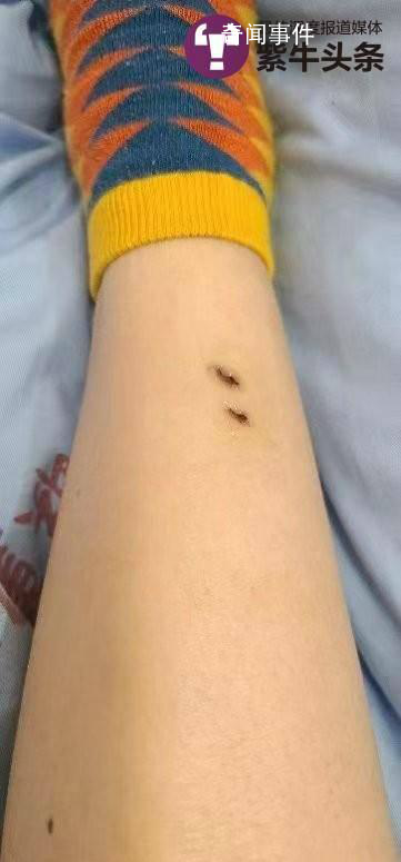女子住酒店被毒蛇咬傷 酒店拒擔全責