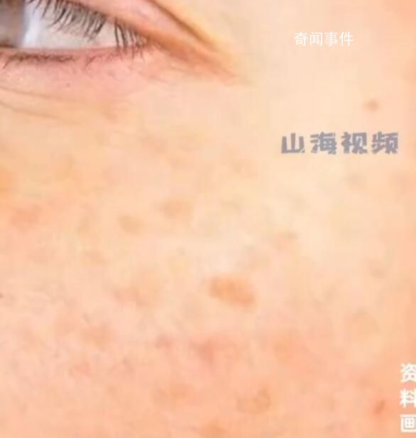 25歲女生長期熬夜長出老年斑 網友看后都心有戚戚焉