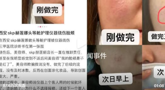 網(wǎng)友曝在赫蓮娜做護(hù)理致臉部燒傷 因儀器有損壞和美容師操作不當(dāng)