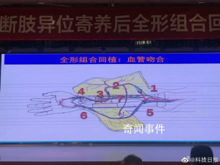 男子斷臂后寄養小腿1月成功回植 該手術屬世界首例