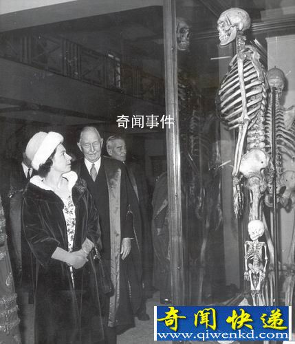 揭秘巨人家族未解之謎 基因突變導致出現巨人癥