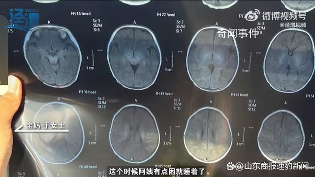 月嫂拍嗝時打盹致嬰兒頭頂骨骨折 治療后醫生建議半年內觀察情況并復查