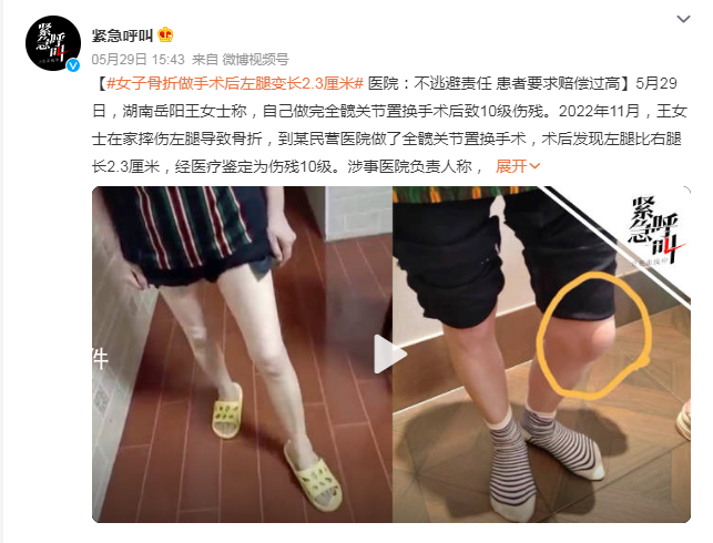 女子骨折做手術(shù)后左腿變長2.3厘米 經(jīng)醫(yī)療鑒定為傷殘10級