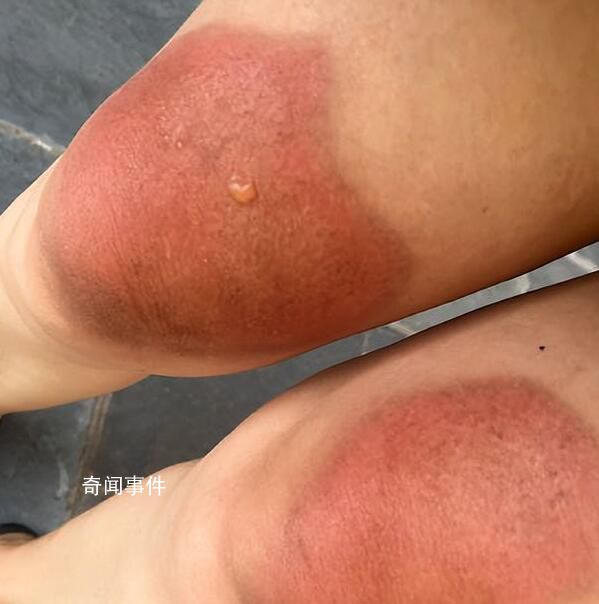 女子云南穿破洞褲7小時(shí)腿被曬傷 希望大家引以為戒