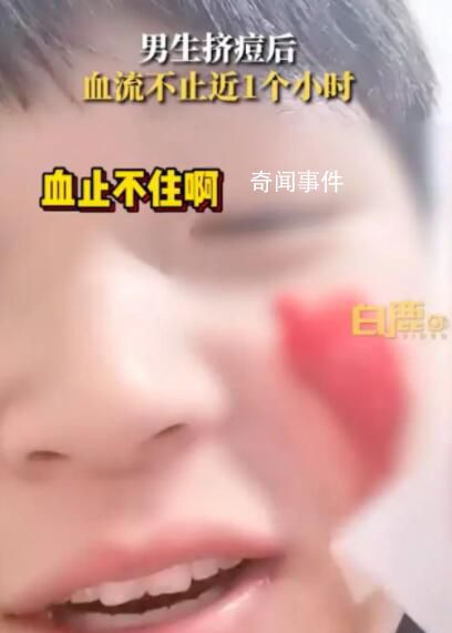 男生擠痘流血近1小時(shí):用了400張紙