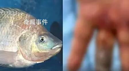 男子被魚刺刺傷致手指壞死被截除 引發(fā)了廣泛關(guān)注