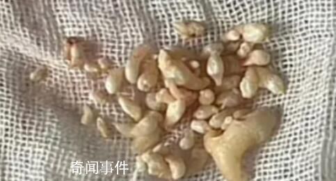 拔掉57顆牙是什么體驗(yàn) 牙瘤是什么病嚴(yán)重嗎
