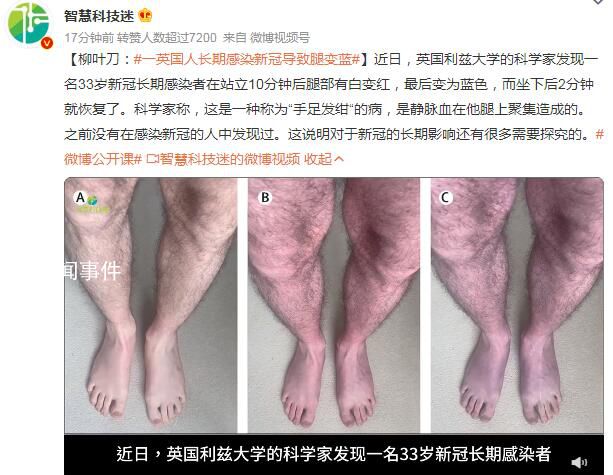 一英國人長期感染新冠導致腿變藍 坐下后2分鐘就恢復了