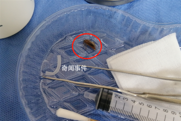 男子半夜臥床玩手機(jī)蟑螂鉆進(jìn)耳朵 傳來一陣劇烈的疼痛