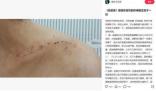 胡歌被曝拍偽裝者時砸斷女主鎖骨 因為要拍戲只能進行手術打了七顆鋼釘