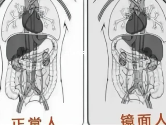 女子就醫(yī)發(fā)現(xiàn)五臟六腑全長(zhǎng)反 什么是鏡面人
