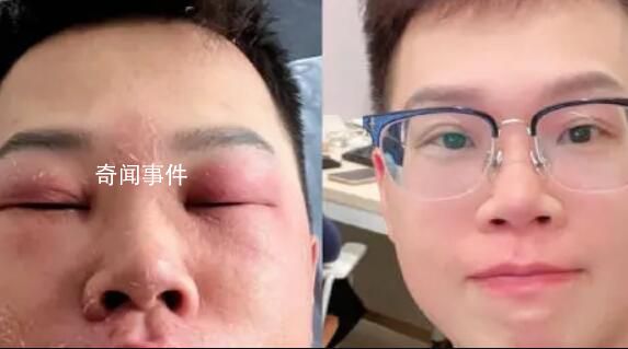 小伙稱因長期摳鼻子感染丹毒 面部還有些紅印在做光療