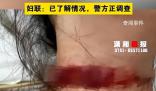 女子稱孕期遭家暴被丈夫拿刀割脖子 目前警方正在調查處理