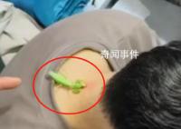 螳螂“大夫”為男子醫(yī)治脖后瘊子