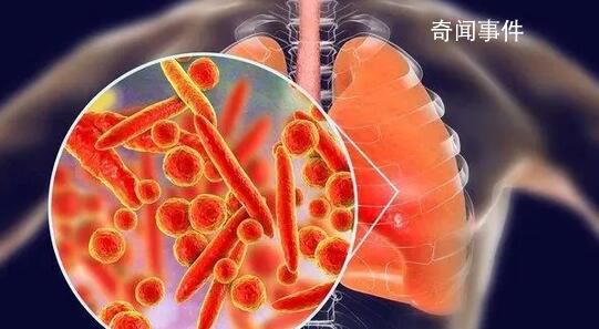 支原體肺炎有后遺癥嗎?專家回應(yīng)