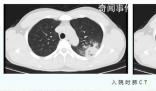 醫生:支原體肺炎成人也會中招 成人患者較以往增多