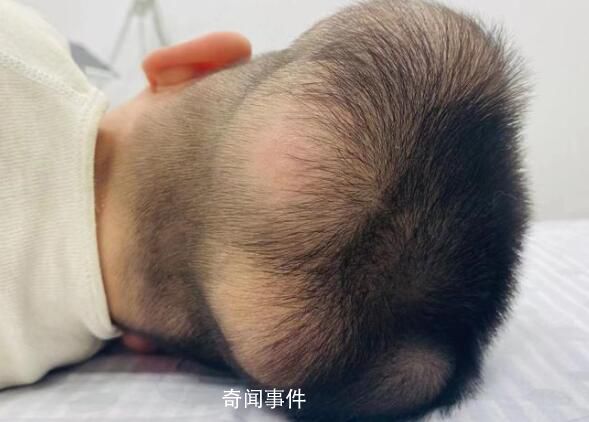 5歲男童患“超級罕見病” 國內此前僅報道過1例