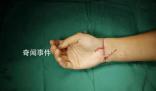 29歲小伙手腕被切斷醫(yī)生通宵縫合