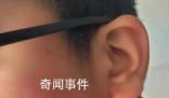 疑因算錯(cuò)題小學(xué)生被老師打耳光 致視力嚴(yán)重受損