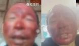 女婿去世女兒住院 男子燒傷不舍就醫(yī)