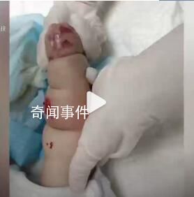 嬰兒遇輸液滲水起大片紅腫水泡 目前醫院正在積極處理