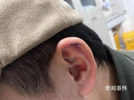 小伙理發(fā)時耳朵被剪縫六針 雙方?jīng)Q定等拆線后據(jù)傷情再協(xié)商