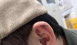 小伙理發時耳朵被剪縫六針 雙方決定等拆線后據傷情再協商